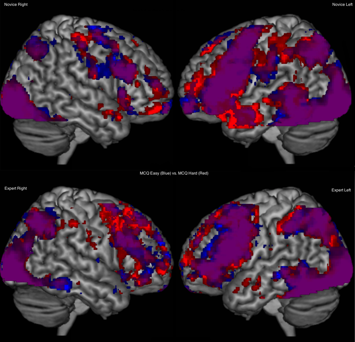 Scans show the difference in right and left hemisphere activation in novice and expert brains during clinical decision-making. Top left and right, the novice brain processing easy cases (blue), hard cases (red) and common areas of activation on easy and hard (purple). Bottom left and right show the expert brain processing the same cases. 